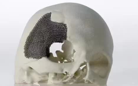 顱骨3D打印技術(shù)是什么？